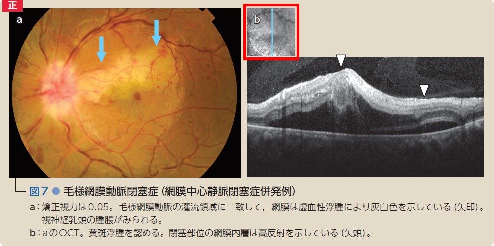 眼底図譜 カラーアトラス　【裁断済み】 カラーアトラス眼底図譜 – 日本医事新報社